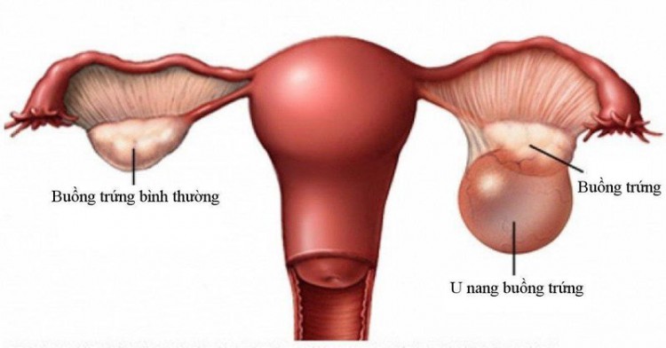 U nang buồng trứng là gì? Nguyên nhân, biểu hiện và cách khắc phục.