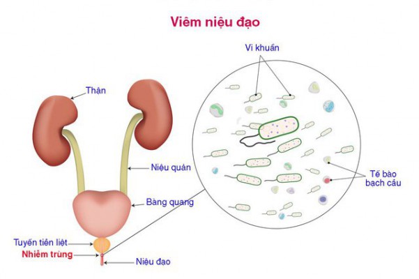 5 dấu hiệu của bệnh viêm niệu đạo không thể chủ quan