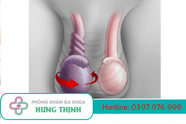 Phương pháp điều trị xoắn tinh hoàn hiệu quả