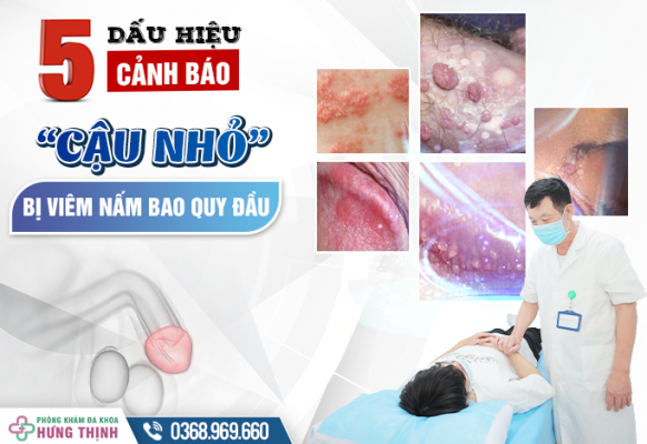 5 Dấu Hiệu Cảnh Báo “Cậu Nhỏ” Bị Viêm Nấm Bao Quy Đầu