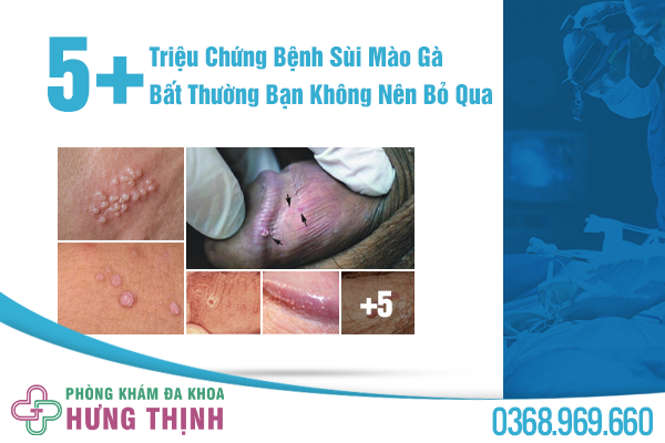 5+ Triệu Chứng Bệnh Sùi Mào Gà Bất Thường Bạn Không Nên Bỏ Qua