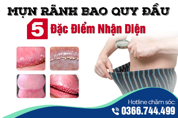 5 Đặc Điểm Nhận Diện Mụn Rãnh Bao Quy Đầu Nam Giới Dễ Dàng Tại Nhà