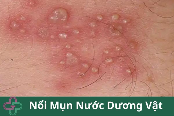 NỔI MỤN NƯỚC Ở BAO QUY ĐẦU LÀ TRIỆU CHỨNG CỦA BỆNH GÌ? NGUYÊN NHÂN VÀ CÁCH CHỮA TRỊ