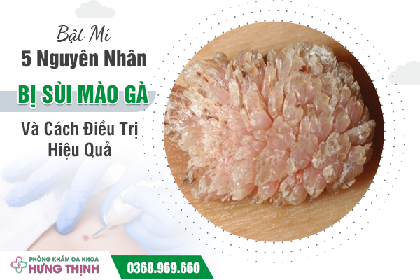 Bật Mí 5 Nguyên Nhân Bị Sùi Mào Gà Và Cách Điều Trị Hiệu Quả 