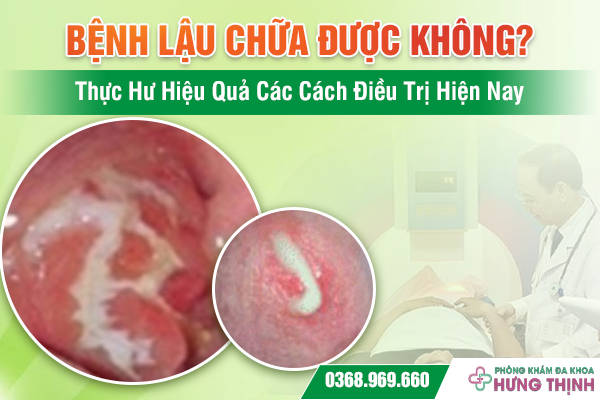 Bệnh Lậu Chữa Được Không? Thực Hư Hiệu Quả Các Cách Điều Trị Hiện Nay