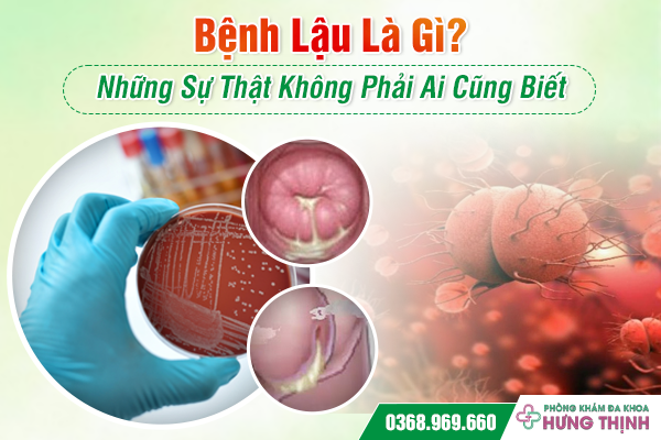 Bệnh Lậu Là Gì? Những Sự Thật Không Phải Ai Cũng Biết