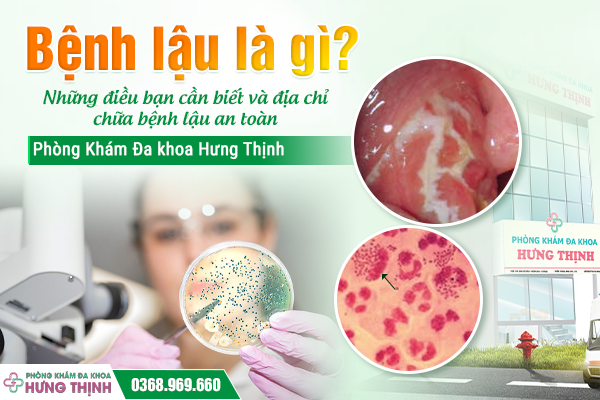 Bệnh lậu là gì? Những điều bạn cần biết và địa chỉ chữa bệnh lậu an toàn - Phòng Khám Đa khoa Hưng Thịnh