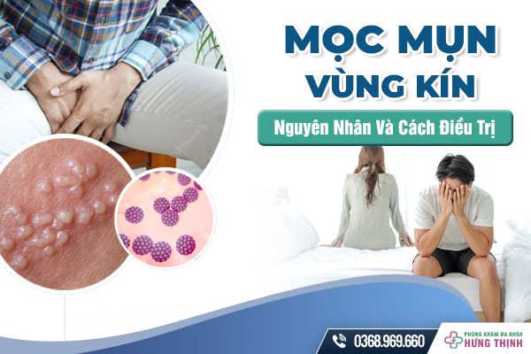 Bị Mọc Mụn Ở Vùng Kín Có Sao Không? Nguyên Nhân Và Cách Điều Trị