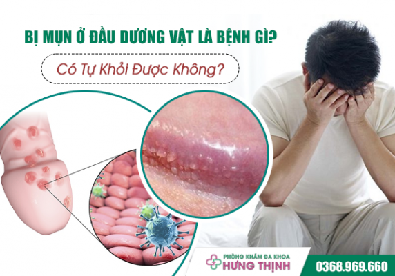  Bị Mụn Ở Đầu Dương Vật Là Bệnh Gì? Có Tự Khỏi Được Không?