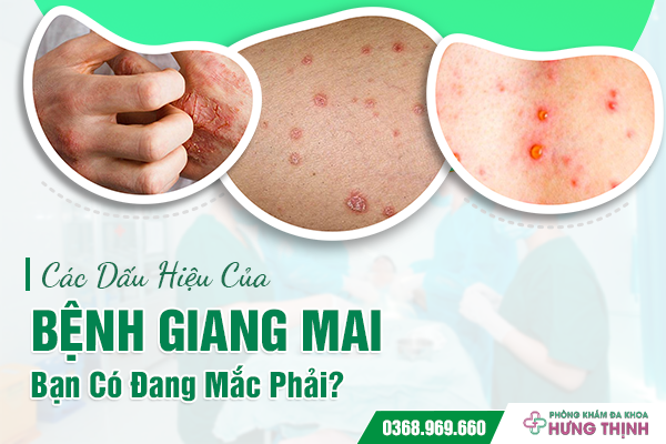 Các Dấu Hiệu Của Bệnh Giang Mai Bạn Có Đang Mắc Phải?