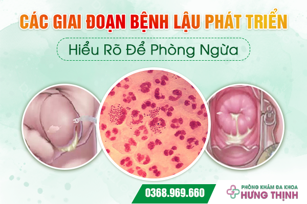  Các Giai Đoạn Bệnh Lậu Phát Triển - Hiểu Rõ Để Phòng Ngừa