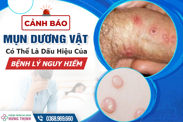 [Cảnh Báo] Bị Mụn Dương Vật Có Thể Là Dấu Hiệu Của Bệnh Lý Nguy Hiểm