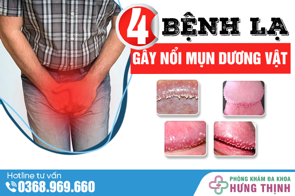 Mọc Mụn Dương Vật Dấu Hiệu Cảnh Báo 4 Bệnh Lý Nguy Hiểm Ở Nam Giới
