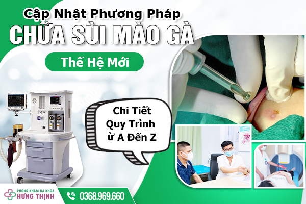 Cập Nhật Phương Pháp Chữa Sùi Mào Gà Thế Hệ Mới - Chi Tiết Quy Trình Từ A Đến Z