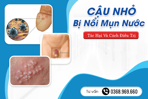 Cậu Nhỏ Bị Nổi Mụn Nước Là Bệnh Gì? Tác Hại Và Cách Điều Trị