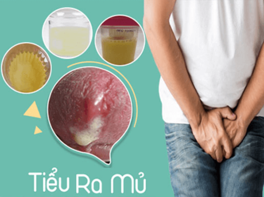 Tiểu buốt ra mủ cảnh báo bệnh gì?