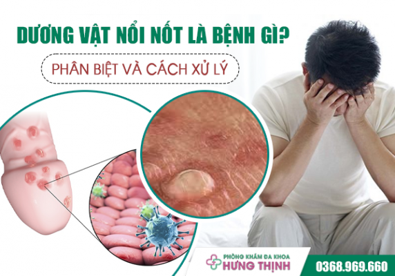  Dương Vật Nổi Nốt Là Bệnh Gì? Phân Biệt Và Cách Xử Lý