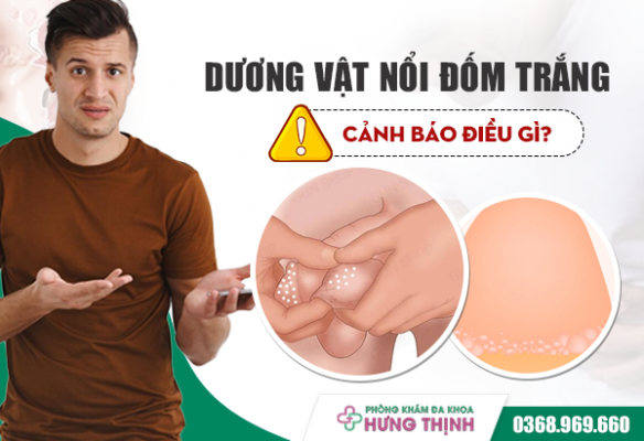  Dương Vật Nổi Đốm Trắng Cảnh Báo Điều Gì?