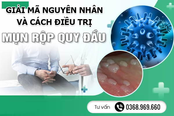 Giải Mã Nguyên Nhân Và Cách Điều Trị Mụn Rộp Quy Đầu