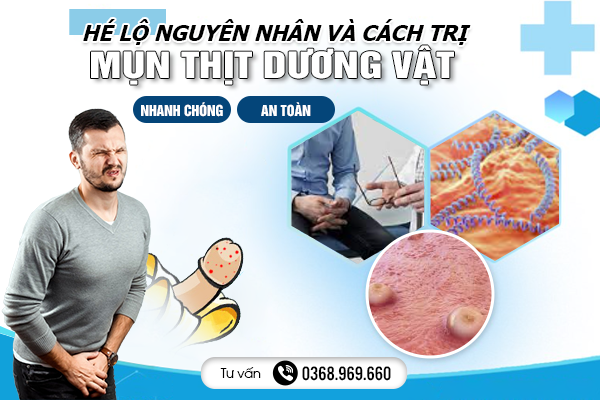 Hé Lộ Nguyên Nhân Và Cách Trị Mụn Thịt Ở Dương Vật Nhanh Chóng, An Toàn