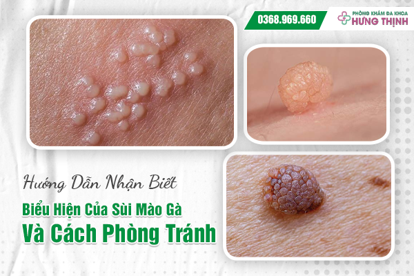 Hướng Dẫn Nhận Biết Biểu Hiện Của Sùi Mào Gà Và Cách Phòng Tránh