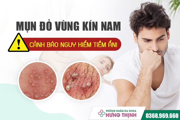 Mọc mụn đỏ ở vùng kín nam giới: Cảnh báo nguy hiểm tiềm ẩn!