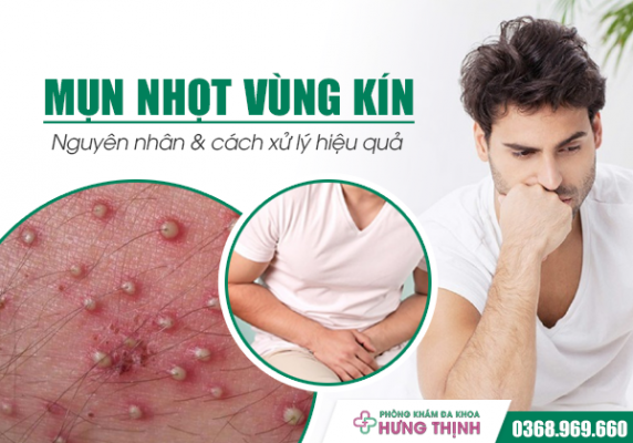 Mụn Nhọt Vùng Kín - Nỗi Lo  Âm Thầm: Nguyên Nhân & Cách Xử Lý Hiệu Quả