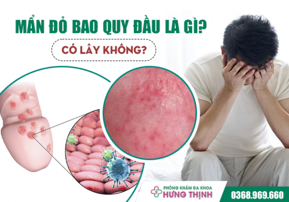  Mẩn Đỏ Bao Quy Đầu Là Gì? Có Lây Không?