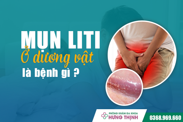Mọc Mụn Li Ti Ở Dương Vật Biểu Hiện Của Bệnh Gì?
