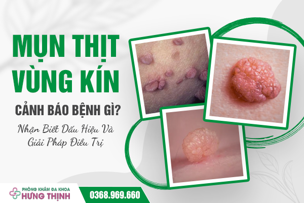 Mụn Thịt Vùng Kín Cảnh Báo Bệnh Gì? Nhận Biết Dấu Hiệu Và Giải Pháp Điều Trị