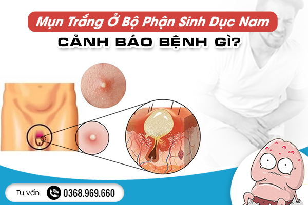  Mụn Trắng Ở Bộ Phận Sinh Dục Nam Cảnh Báo Bệnh Gì? Triệu Chứng Và Phương Pháp Điều Trị