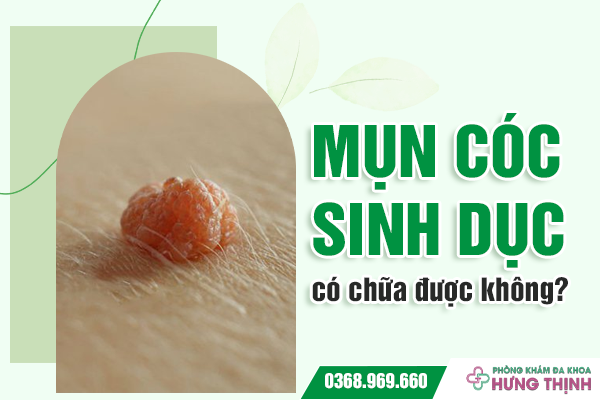 Mụn cóc sinh dục có chữa được không? Liệu có giải pháp chấm dứt mụn cóc sinh dục?