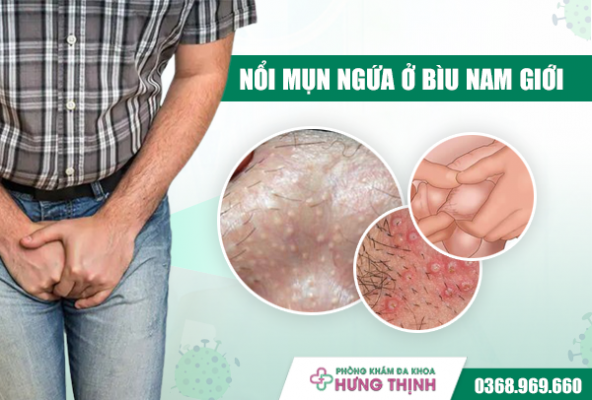 Giải Mã Hiện Tượng Nổi Mụn Ngứa Ở Bìu Nam Giới Là Bệnh Gì?