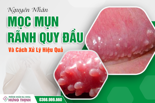  Nguyên Nhân Mọc Mụn Rãnh Quy Đầu Và Cách Xử Lý Hiệu Quả