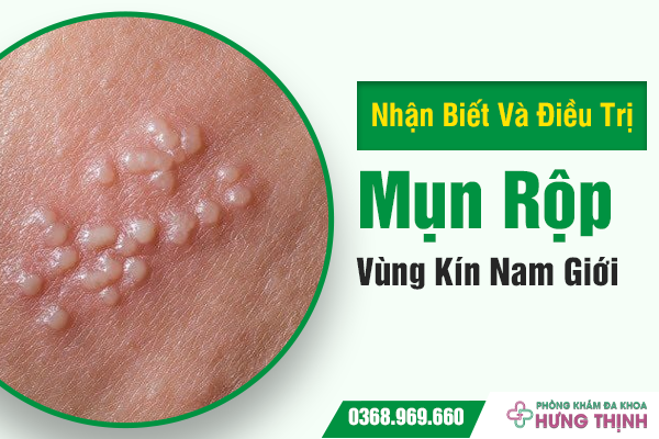 Nhận Biết Và Điều Trị Mụn Rộp Vùng Kín Nam Giới
