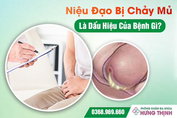 Niệu Đạo Bị Chảy Mủ Là Dấu Hiệu Của Bệnh Gì?