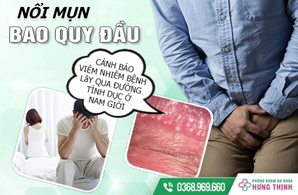 NỔI MỤN Ở BAO QUY ĐẦU - CẢNH BÁO VIÊM NHIỄM BỆNH LÂY QUA ĐƯỜNG TÌNH DỤC Ở NAM GIỚI 