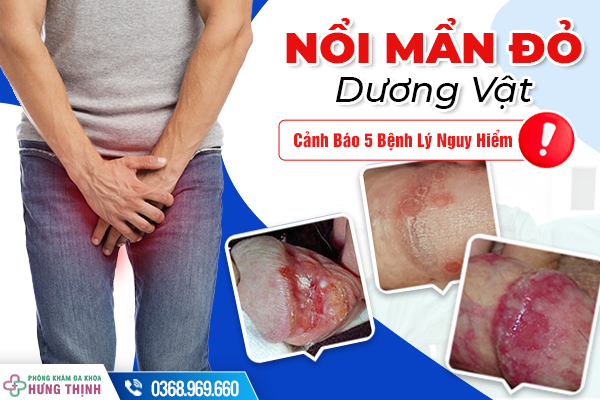 Nổi Mẩn Đỏ Dương Vật: Cảnh Báo Bệnh Lý Tiềm Ẩn Và Cách Khắc Phục