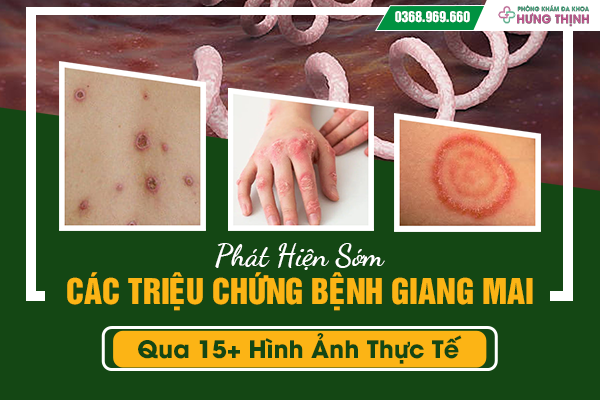 Phát Hiện Sớm Các Triệu Chứng Của Bệnh Giang Mai Qua 15+ Hình Ảnh Thực Tế