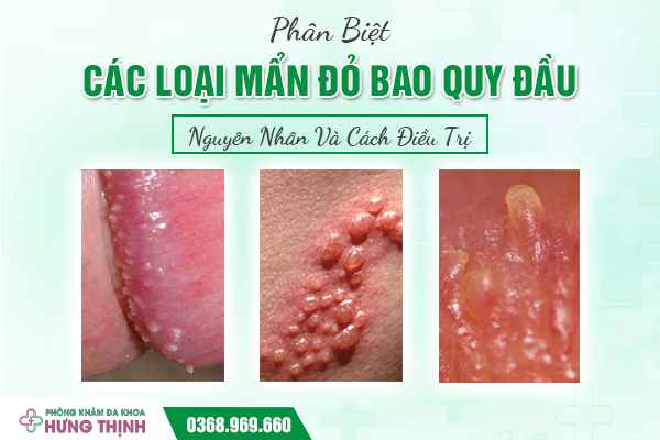 Phân Biệt Các Loại Mẩn Đỏ Bao Quy Đầu: Nguyên Nhân Và Cách Điều Trị