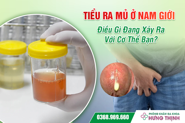 Tiểu Ra Mủ Ở Nam Giới - Điều Gì Đang Xảy Ra Với Cơ Thể Bạn?