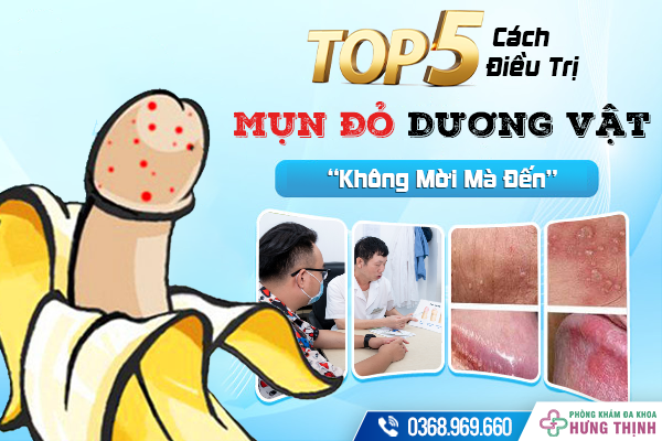 Top 5+ Cách Đơn Giản Điều Trị Mụn Đỏ Ở Dương Vật “Không Mời Mà Đến”
