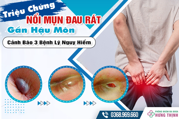 Triệu Chứng Nổi Mụn Đau Rát Gần Hậu Môn Cảnh Báo 3 Bệnh Lý Nguy Hiểm Mà Bạn Cần Biết