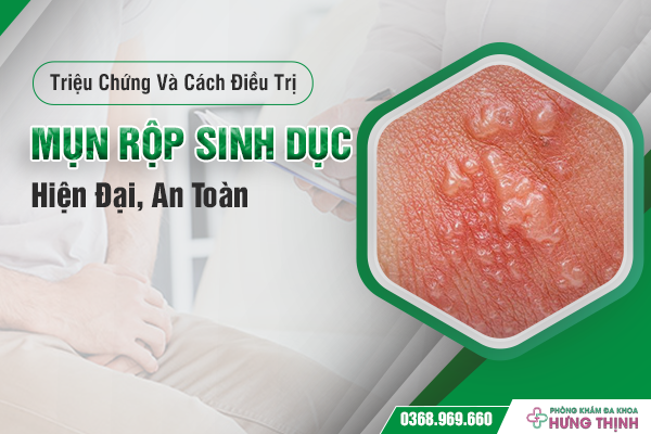 Triệu Chứng Và Cách Điều Trị Mụn Rộp Sinh Dục Hiện Đại, An Toàn