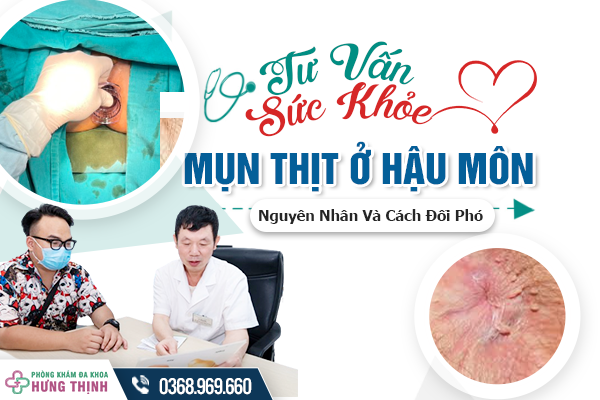 [Tư Vấn Sức Khỏe] Nguyên Nhân Và Cách Đối Phó Tình Trạng Nổi Mụn Thịt Ở Hậu Môn