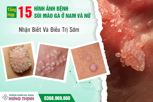 Tổng Hợp 15 Hình Ảnh Bệnh Sùi Mào Gà Ở Nam Và Nữ: Nhận Biết Và Điều Trị Sớm