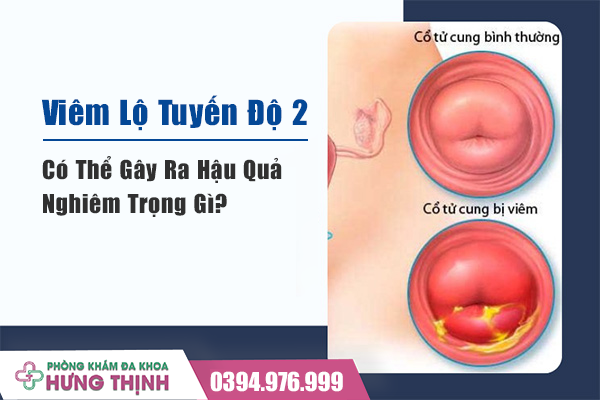 Viêm Lộ Tuyến Độ 2 Có Thể Gây Ra Hậu Quả Nghiêm Trọng Gì?
