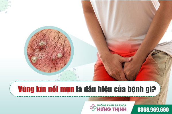 Vùng kín nổi mụn là dấu hiệu của bệnh gì?