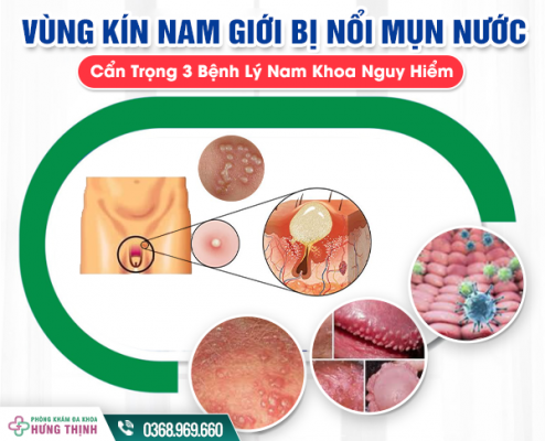 Vùng Kín Nam Giới Bị Nổi Mụn Nước Phải Làm Sao? Cẩn Trọng 3 Bệnh Lý Nam Khoa Nguy Hiểm
