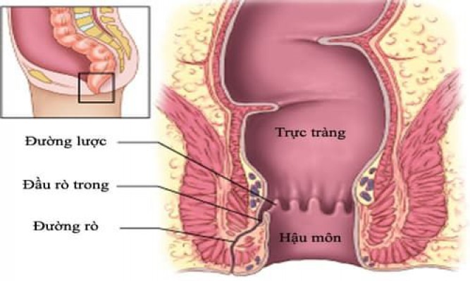 Thế nào là bệnh rò hậu môn?